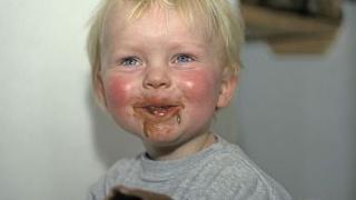 Диатез. Нервно-артритический диатез у детей: причины, симптомы, лечение