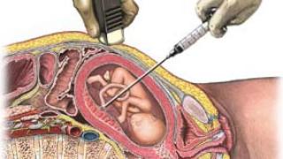 Кордоцентез – делать или нет?